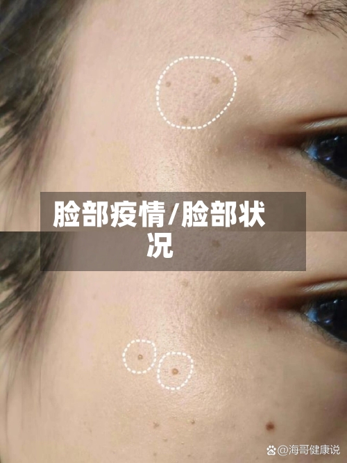 脸部疫情/脸部状况-第3张图片