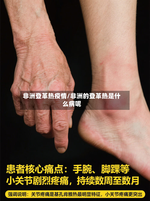 非洲登革热疫情/非洲的登革热是什么病呢