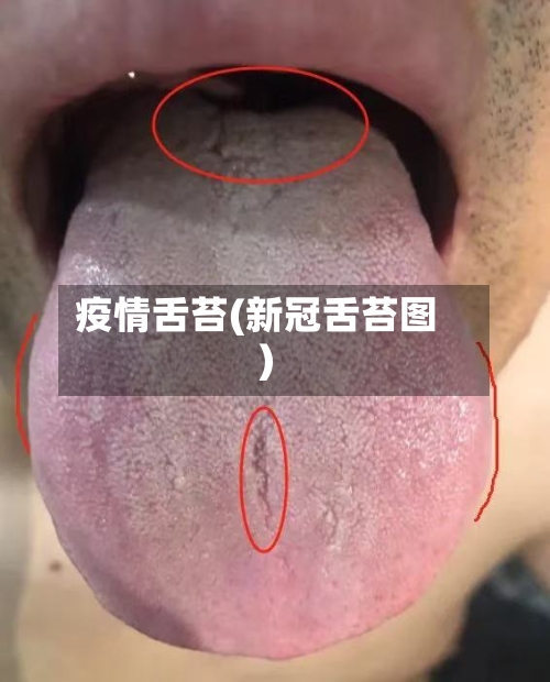 疫情舌苔(新冠舌苔图)